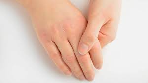 Image result for Vitamin Deficiency