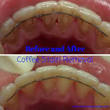 Whenever you drink coffee and you think that your teeth may get stained then always use mouthwash after drinking it. Before And After A Cleaning To Remove Coffee And Tea Stains Parkridgedentist Dentalhygienist Beforeandafter Coffee Stain Removal Tea Stains Coffee Staining