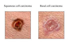 Image result for basal cell carcinoma