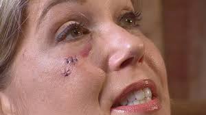 Woman reeling from stray cat attack