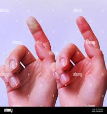 Image result for Capillary Refill