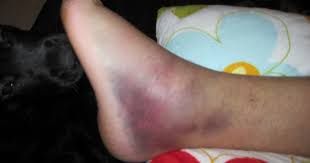 Day 3 and 4: An air cast, and a Dr.'s note to his professors