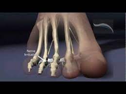Do You Suffer From Morton S Neuroma Youtube Morton S Neuroma Neuroma Foot Health