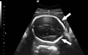 Private anomaly scan is used for a detailed look at how your growing baby is developing physically and also scans for any abnormalities. The Lemon Sign Shown On Antenatal Ultrasound Scan Posterior And Download Scientific Diagram