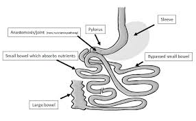 Loop Duodenal Switch Sadi S Sips General Surgeon Gold Coast Weight Loss Surgery Bariatric Surgery Liver Surgery Hernia Surgery Specialist Dr Harald Puhalla