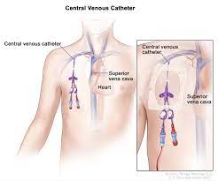 Tunneled Central Venous Catheter | Children's Hospital Of Philadelphia