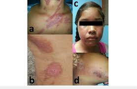 Image result for Linear Dermatitis