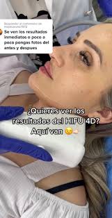 Tratamiento Hifu Facial Antes Y Fespues