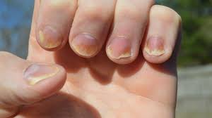 Psoriasis Kuku Kenali Gejala Penyebab Dan Cara Mengatasinya