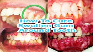 home remes for gum pain and swelling