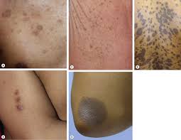 Image result for Diffuse Hyperpigmentation