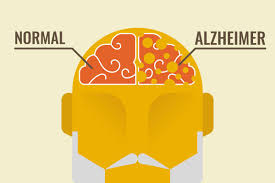 Imate Li Alzheimera Rijesite Test I Saznajte To Na Vrijeme 24sata