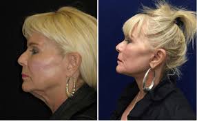 Please use imgur, gfycat or reddituploads for your post! What S The Best Way To Treat Sagging Jowls Walnut Creek Neck Lift Aycock Md