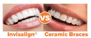 What is the best retainer after braces? How Much Do Clear Braces Cost Vs Invisalign Ncoso