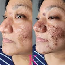 Fibroblast by KarinaJ