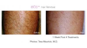 Their slogan is backed up by years of experience that most beauty centers. Laser Hair Removal Calgary Merle Norman Market Mall