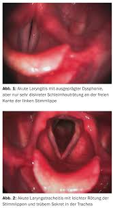 Image result for Acute Laryngitis