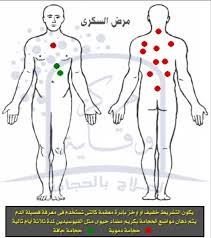 مواضع حجامة داء السكري مركز وقاية للحجامة بالكويت الحجامة بالكويت حجام بالكويت