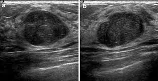 Malignant phyllodes tumor of the breast: Https Www Umbjournal Org Article S0301 5629 13 00008 2 Pdf