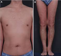 Mark lebwohl, md, dean for clinical therapeutics and chairman emeritus. Pdf Classic Juvenile Pityriasis Rubra Pilaris Treated With Oral Alitretinoin Semantic Scholar