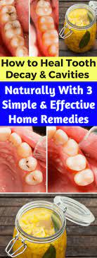 How To Heal Tooth Decay And Cavities Naturally With 3 Simple And Effective Home Remedies Daily Health Advisor Natural Colon Cleanse Tooth Decay Cavities