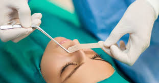 A surgeon uses a thin tube with a camera to locate and remove nasal polyps and open the sinus passages. Septoplasty What To Expect Risks And Reasons For Surgery