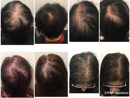 No harmful pharmaceutical hair loss drugs. Prp Hair Loss Treatment Skin Clinics In Melbourne Sydney
