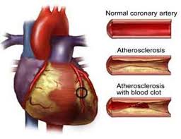 Myocarditis, also known as inflammatory cardiomyopathy, is inflammation of the heart muscle.symptoms can include shortness of breath, chest pain, decreased ability to exercise, and an irregular heartbeat. Afectiuni Cardiovasculare Modulul 5 Biochimie