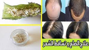 علاج تساقط الشعر و علاج الصلع و تقوية الشعر خاصة من الامام للرجال و النساء وصفة سحرية youtube hair styles hair style