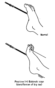 Image result for Reflex Exam