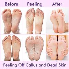 There are many different brands when it comes to foot peels; Buy Maybeau 4 Pairs Foot Peel Mask Exfoliating Baby Foot Mask Set Peeling Away Callus And Dead Skin Natural Lavender And Olive Scented Booties Repair Rough Heels Treatment Soft Smooth Touch Baby