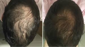 Topical applications ​ in liquid and shampoo forms, to prevent hair loss, contain dosages ranging from ​ 0.002 milliliter ​ per 1 milliliter to ​.06 milliliters ​ per 100 milliliters. Which Is The Best Biotin Supplement For Hair Available In India Quora