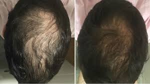 These musclexp vegetarian tablets are suitable for men and women. Which Is The Best Biotin Supplement For Hair Available In India Quora