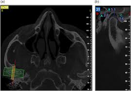 The effect of tooth loss