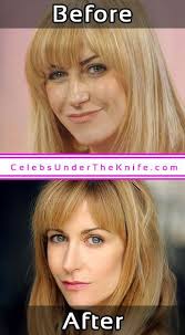 Katherine Kelly Pics Cosmetic Surgery Celebsundertheknife Celebs Celebrity Plasticsurgery Cele Celebrity Surgery Celebrity Plastic Surgery Plastic Surgery
