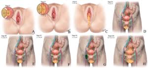 Image result for Vulvar Cancer