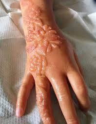 Maybe you would like to learn more about one of these? Intense Chemical Scars After Henna Tattoo Medizzy Journal