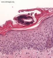 Image result for Sarcoptes scabiei