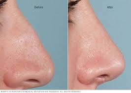 The part of a person's or animal's face. Rhinoplasty Mayo Clinic