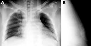 Image result for Sternal Fracture