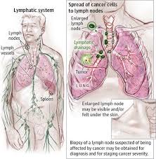 Dr Daniel Liu Danielzliu Lymph Nodes Lung Conditions Lymph Massage