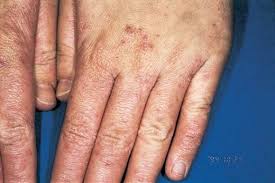 koldaki gunes lekeleri nasil gecer