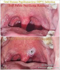 Image result for papillomavirus tongue)