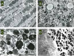 The pathological process is mainly due to the. Plos One In Vivo T2 Weighted Mri Visualizes Cardiac Lesions In Murine Models Of Acute And Chronic Viral Myocarditis