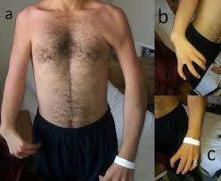Usually first noticed in the early teen years. Concomitant Closure Of Atrial Septal Defect And Correction Of Pectus Excavatum Ctsnet