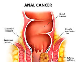 Image of Ung thư hậu môn