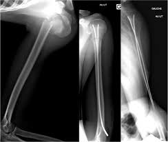 Image result for Humerus Growth Plates