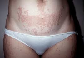 Image result for pruritic urticarial papules and plaques of pregnancy