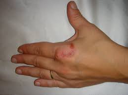 Granuloma Anulare Wikipedia