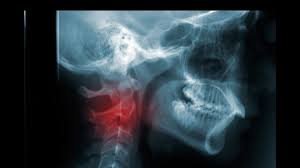 Throat cancer causes, signs and symptoms. Head And Neck Cancer Is More Common Than You Think
